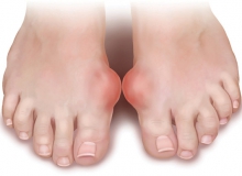 BỆNH GOUT CÓ ẢNH HƯỞNG TRÊN SỨC KHỎE TÌNH DỤC?